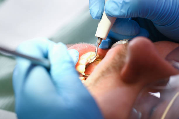 Best Emergency Treatment for Dental Infections or Abscesses in Los Chaves, NM
